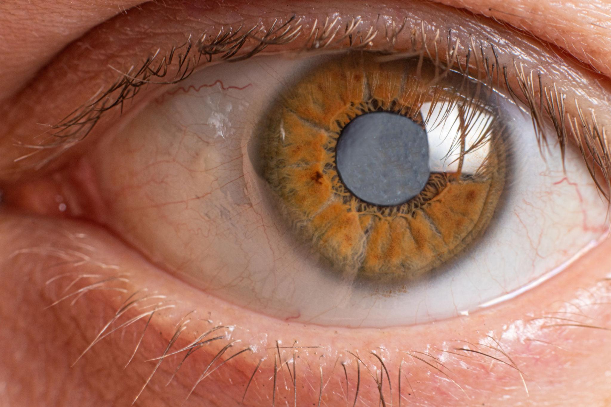 Cataract Care and Lens Planning visual