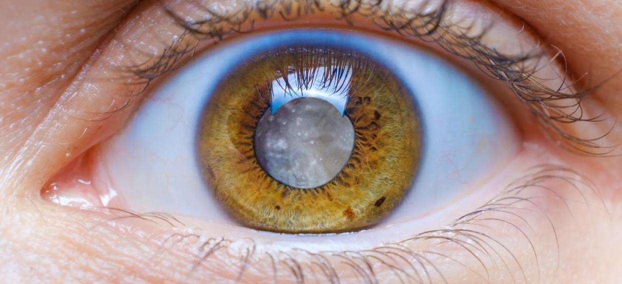 Cataract Care and Lens Planning visual