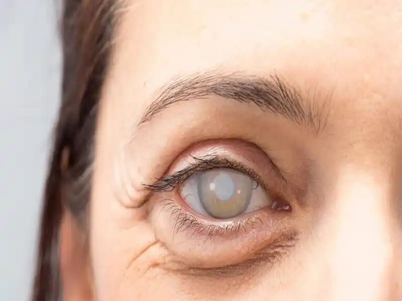 Cataract Care and Lens Planning visual