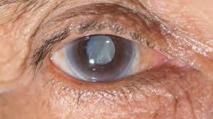 Cataract Care and Lens Planning visual