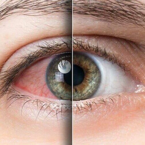 Dry Eye Treatment and Comfort Care visual
