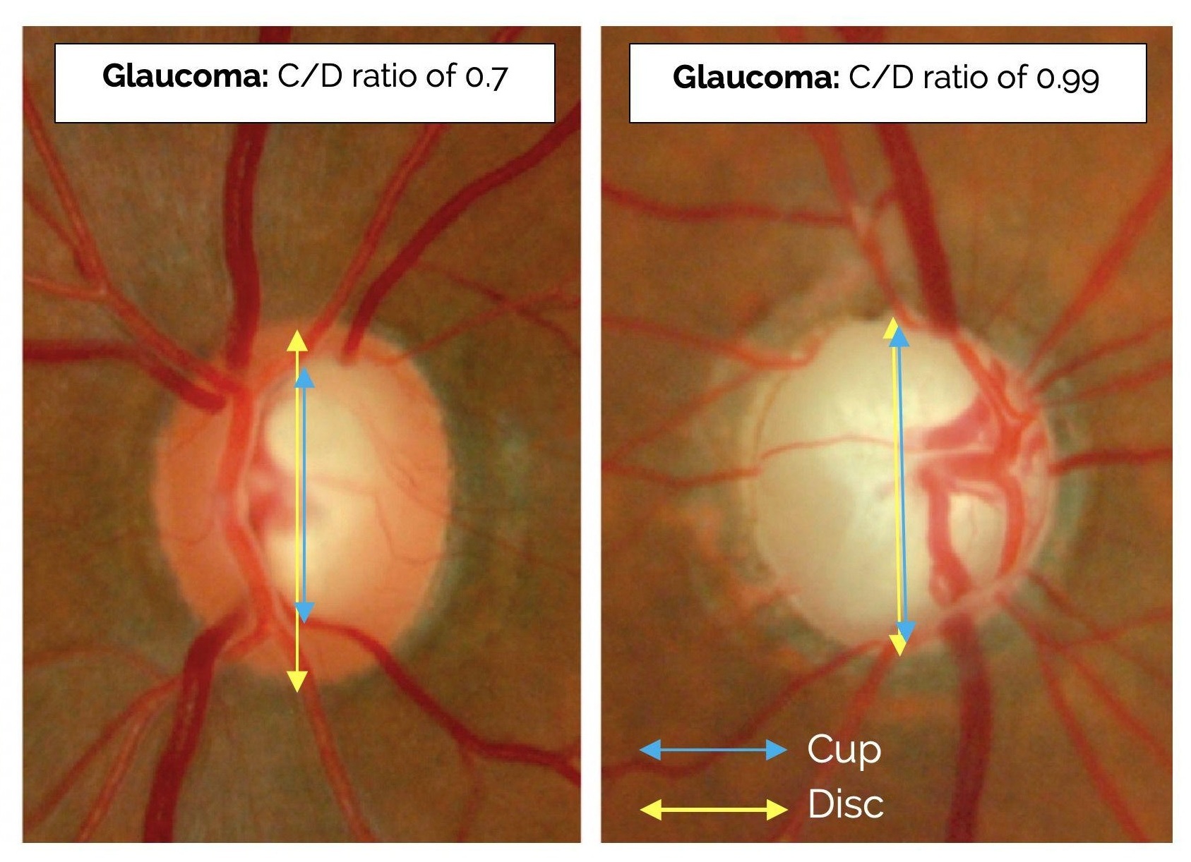 Glaucoma Care and Monitoring visual