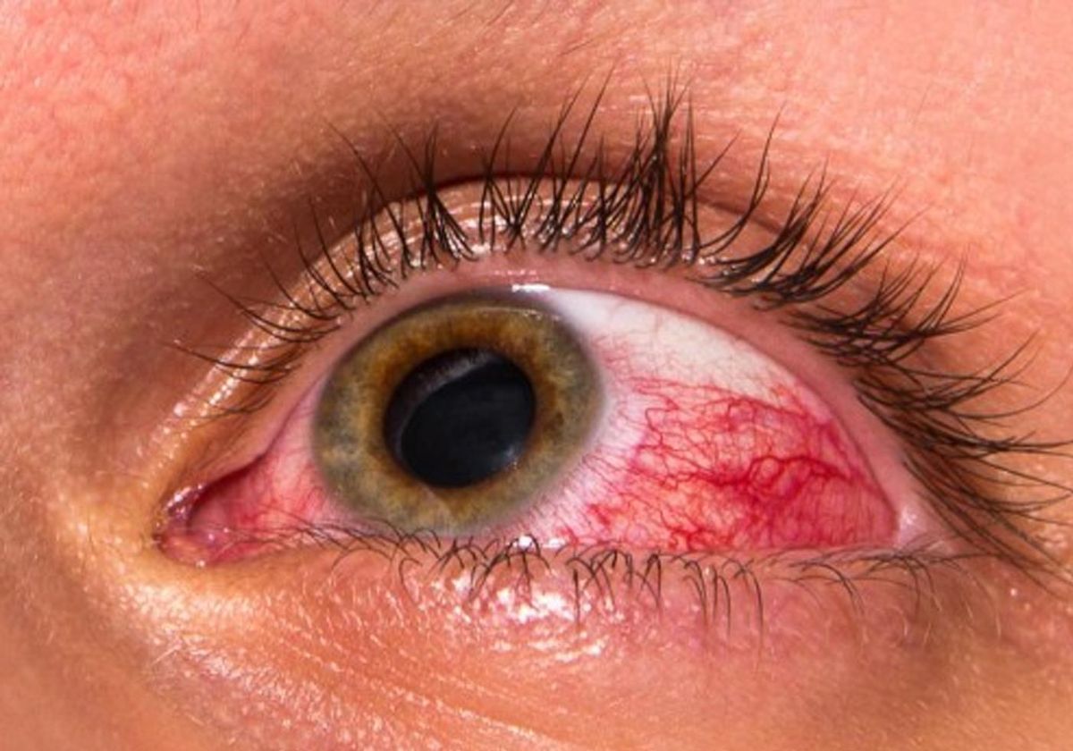 Glaucoma Care and Monitoring visual