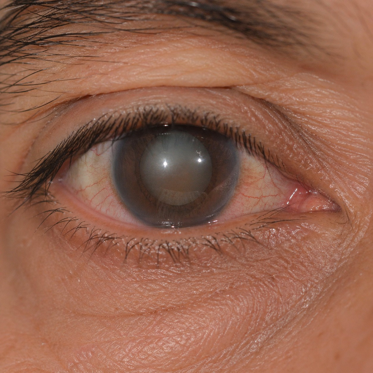 Glaucoma Care and Monitoring visual