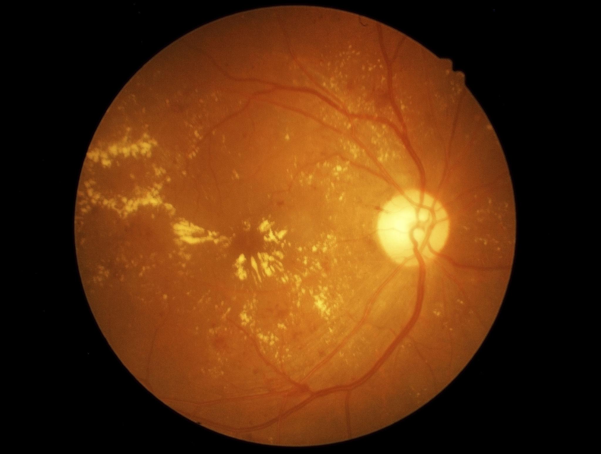 Retina Screening and Diabetic Eye Care visual